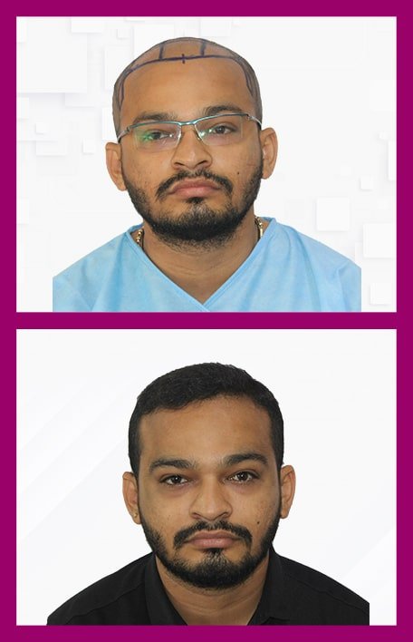 Hair-Transplant-In-Male