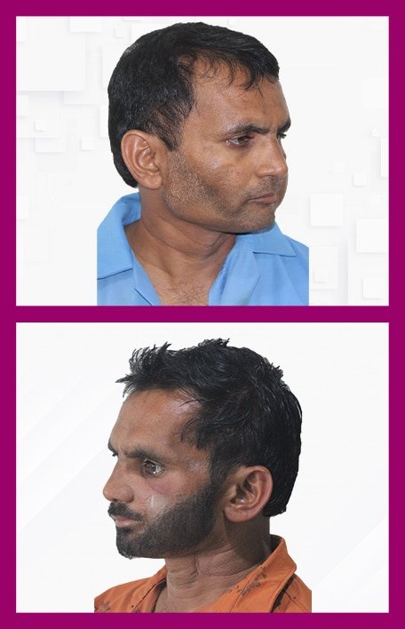 Moustache-&-Beard-Hair-Transplant