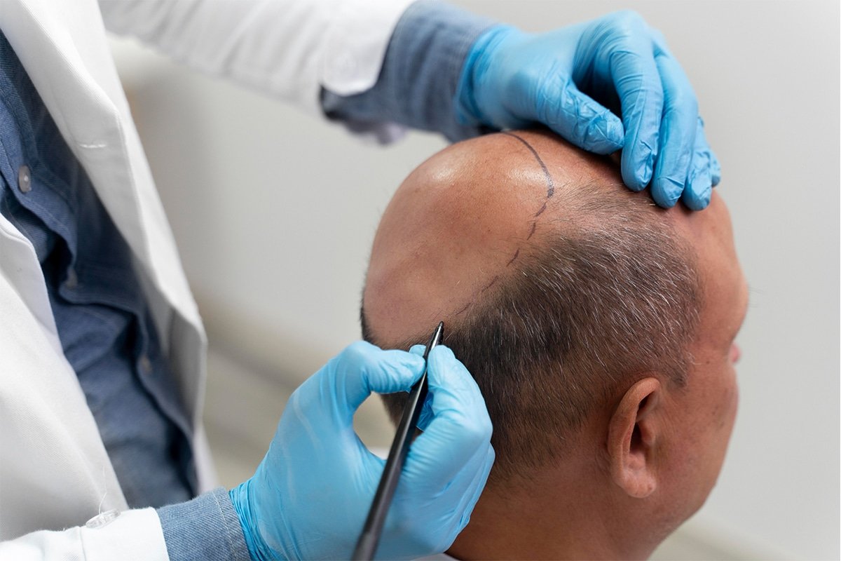 Section 8 (Hair-Transplant)