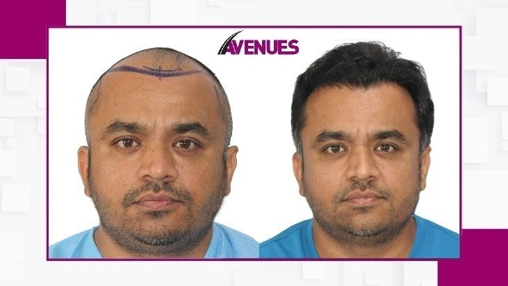 Avenues-Before-After-1