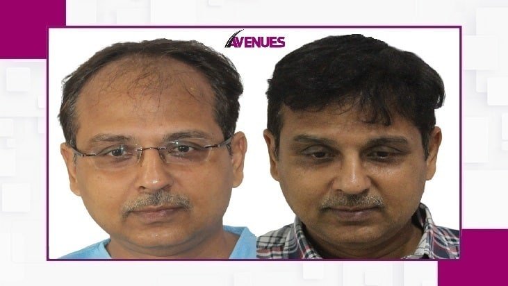 Avenues-Before-After-2